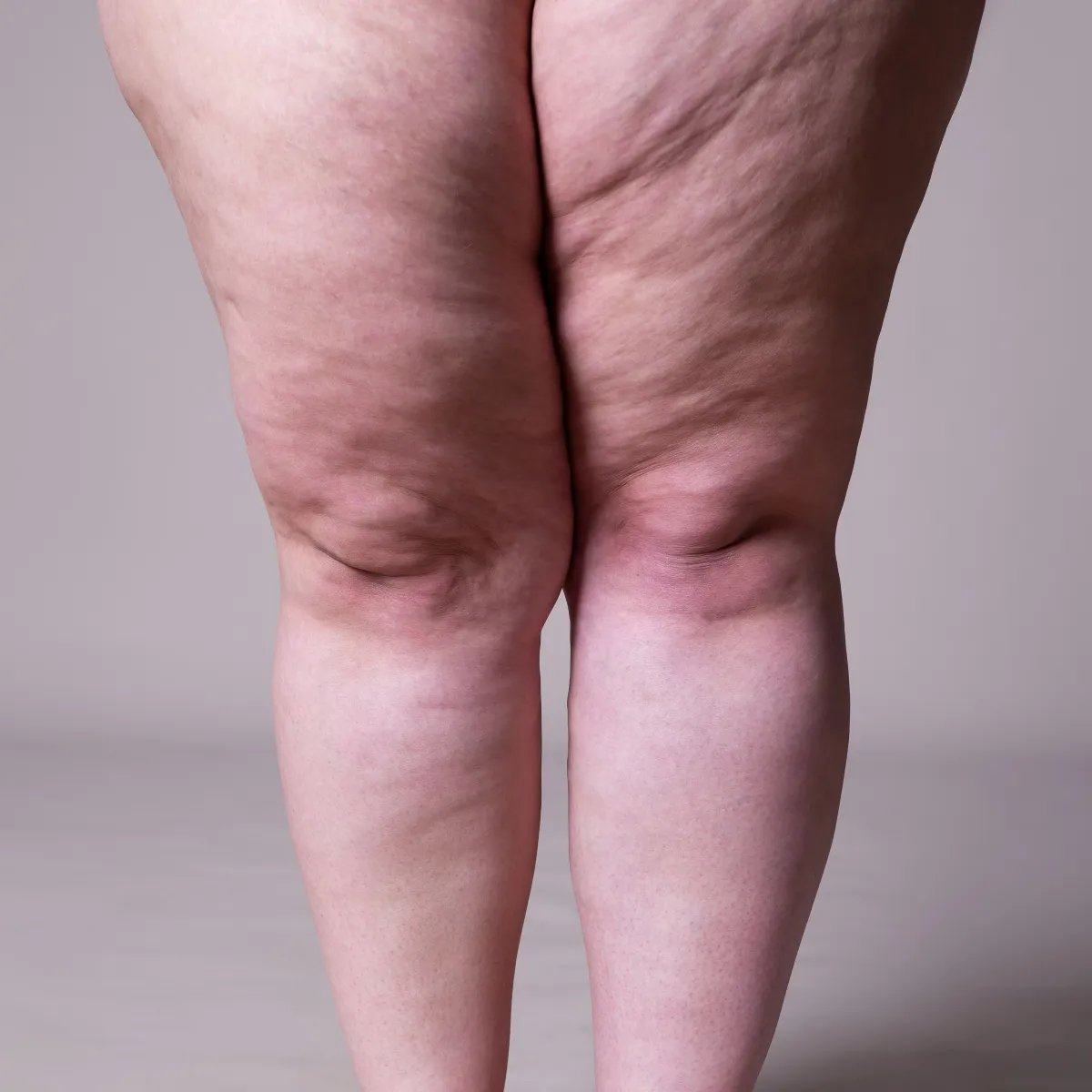 Pernas de uma mulher em close, representando o lipedema